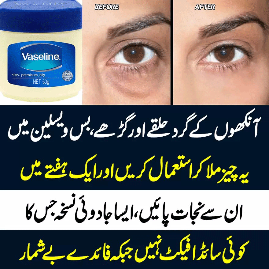 Get Rid of Dark Circles Under Eyes