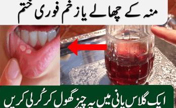 Mouth Sores causes and treatment with home remedies