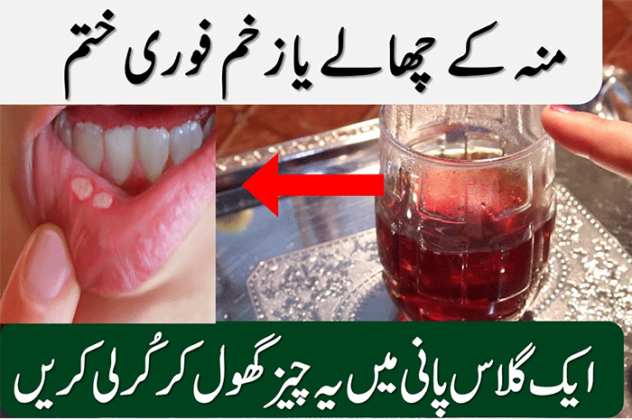 Mouth Sores causes and treatment with home remedies