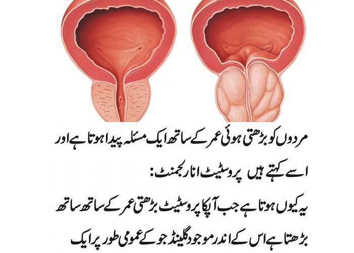 Prostate Causes, Symptoms and Treatment Options for Prostate Cancer