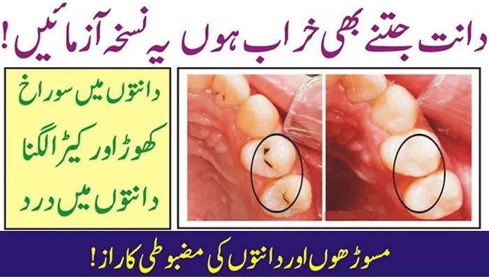 Prevent Gum Disease