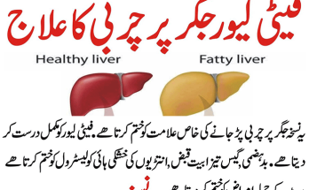 What is Fatty Liver? Causes, Symptoms, Treatment and Prevention